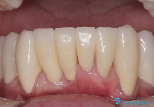 歯周病でグラグラの歯 矯正治療と歯周外科を併用した総合歯科治療の治療後