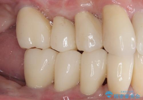 歯周病でグラグラの歯 矯正治療と歯周外科を併用した総合歯科治療の治療後