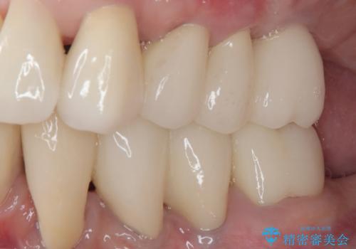 歯周病でグラグラの歯 矯正治療と歯周外科を併用した総合歯科治療の治療後