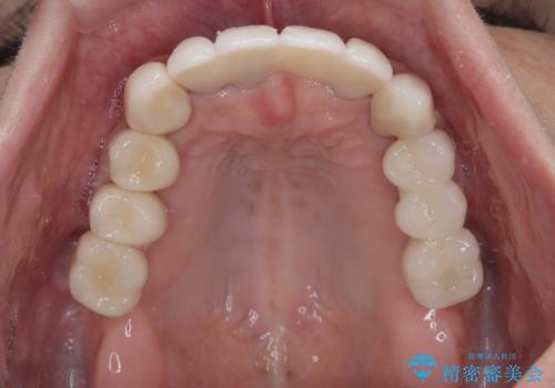 歯周病でグラグラの歯 矯正治療と歯周外科を併用した総合歯科治療の治療後