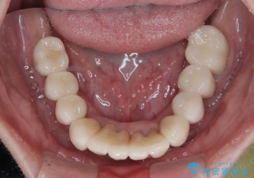 歯周病でグラグラの歯 矯正治療と歯周外科を併用した総合歯科治療の治療後