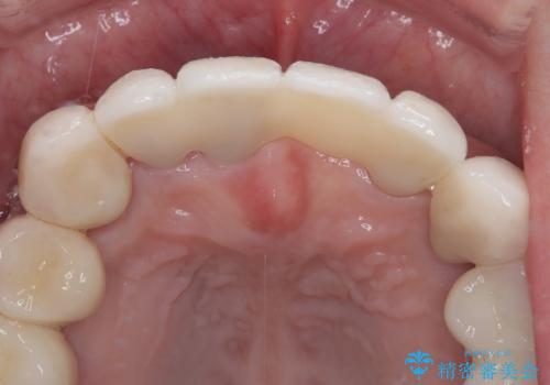 歯周病でグラグラの歯 矯正治療と歯周外科を併用した総合歯科治療の治療後
