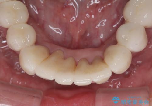 歯周病でグラグラの歯 矯正治療と歯周外科を併用した総合歯科治療の治療後