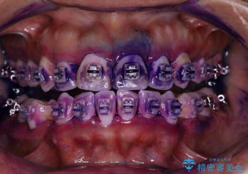 職場で口臭を指摘された (ワイヤー矯正中)