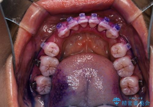 職場で口臭を指摘された (ワイヤー矯正中)の治療前