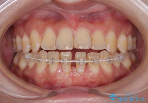 矯正の後戻りによるすきっ歯と歯肉退縮 根面被覆と部分矯正の治療中