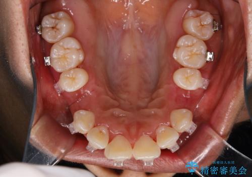 職場で口臭を指摘された (ワイヤー矯正中)の治療後