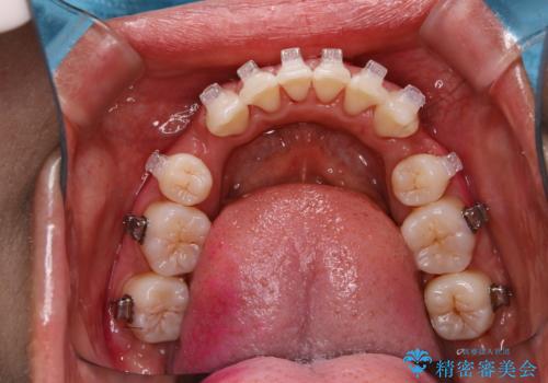 職場で口臭を指摘された (ワイヤー矯正中)の治療後