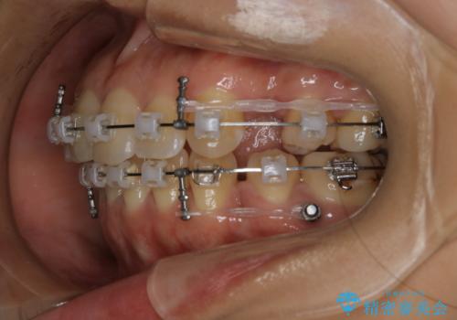 前歯を後ろに下げたい ワイヤー矯正(クリア装置)の治療中