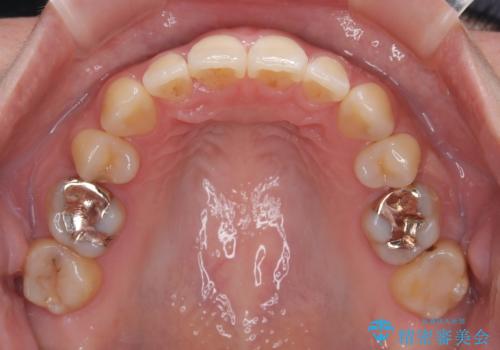 欠損と口元の突出感 ワイヤー装置での抜歯矯正の治療後