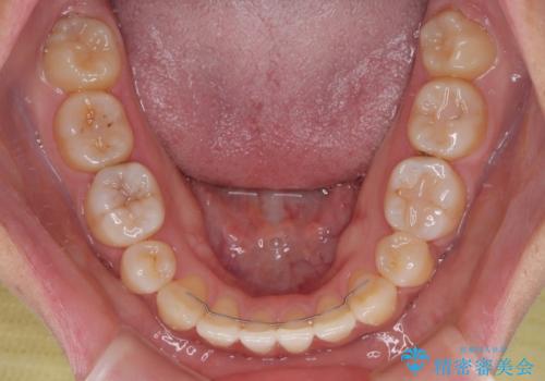 欠損と口元の突出感 ワイヤー装置での抜歯矯正の治療後