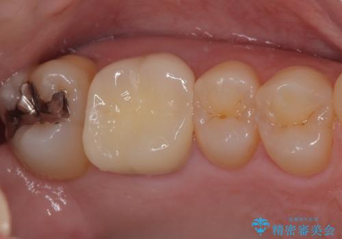 銀歯が外れた。オールセラミッククラウンによる補綴治療