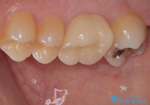 銀歯が外れた。オールセラミッククラウンによる補綴治療の治療後