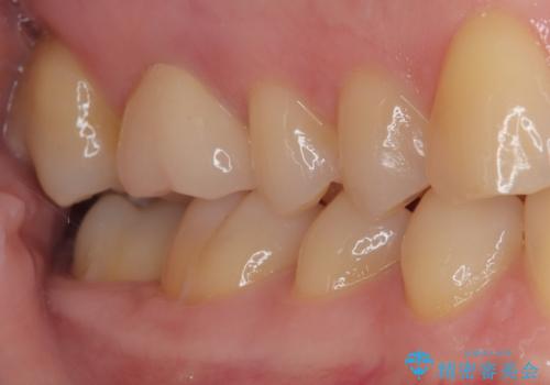 銀歯が外れた。オールセラミッククラウンによる補綴治療の治療後