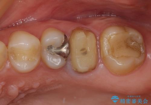 割れてしまった奥歯 インプラント治療の症例 治療前