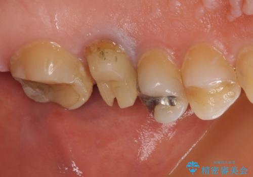 割れてしまった奥歯 インプラント治療の治療前