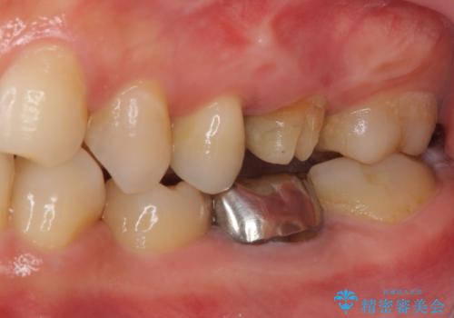 割れてしまった奥歯 インプラント治療の治療前