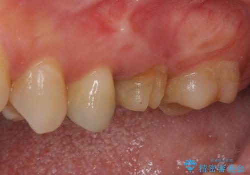 割れてしまった奥歯 インプラント治療の治療前