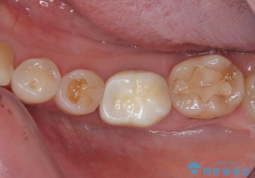 奥歯がたまにしみる フルジルコニアクラウンの補綴治療の症例 治療後