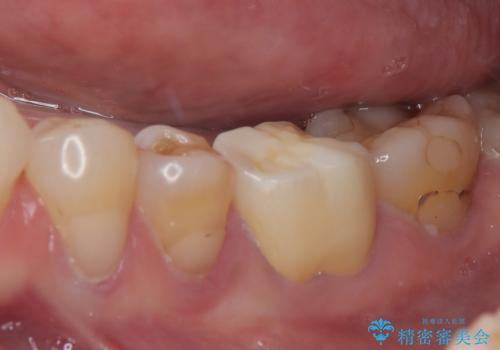奥歯がたまにしみる フルジルコニアクラウンの補綴治療の治療後