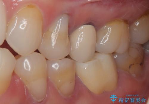 奥歯がたまにしみる フルジルコニアクラウンの補綴治療の治療後