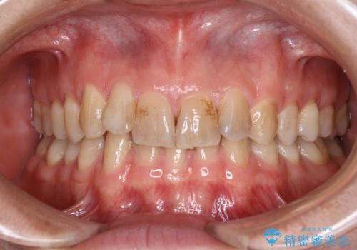 ホワイトニングしようと思っていたが、クリーニングで済んだ!の治療前