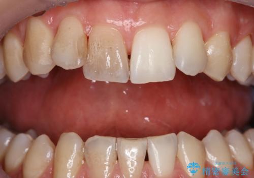 ホワイトニングしようと思っていたが、クリーニングで済んだ!の治療中