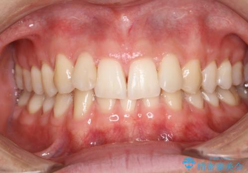 ホワイトニングしようと思っていたが、クリーニングで済んだ!の治療後