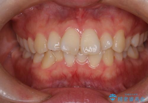 前歯の出っ張りをマウスピースで改善