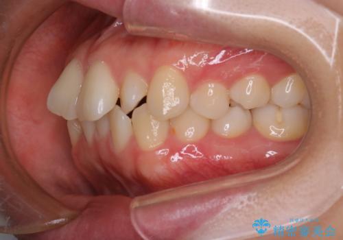 前歯の出っ張りをマウスピースで改善の治療前