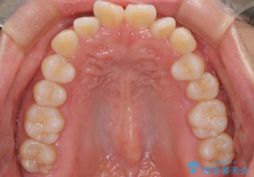 前歯の出っ張りをマウスピースで改善の治療前