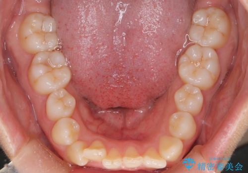 前歯の出っ張りをマウスピースで改善の治療前