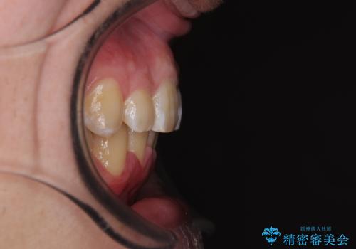 上顎前歯のデコボコを改善してスッキリした口元に ワイヤー装置での非抜歯矯正の治療後