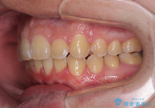 上顎前歯のデコボコを改善してスッキリした口元に ワイヤー装置での非抜歯矯正の治療後