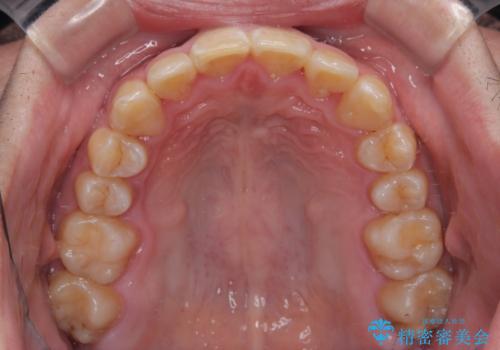 上顎前歯のデコボコを改善してスッキリした口元に ワイヤー装置での非抜歯矯正の治療後