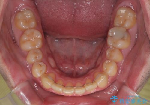 上顎前歯のデコボコを改善してスッキリした口元に ワイヤー装置での非抜歯矯正の治療後