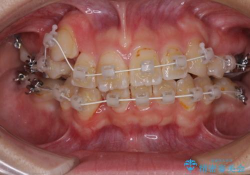 転位歯や埋伏歯などの難易度の高い抜歯矯正治療の治療中