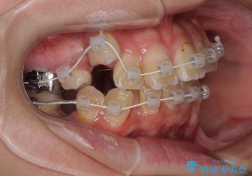 転位歯や埋伏歯などの難易度の高い抜歯矯正治療の治療中
