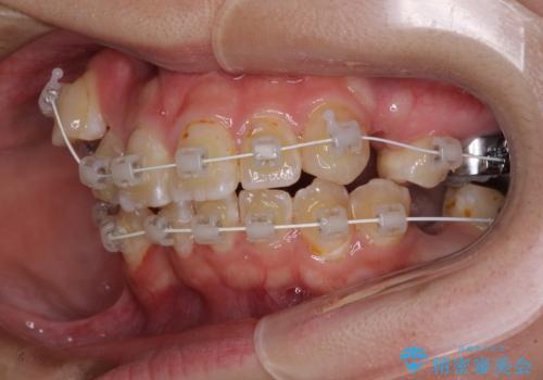 転位歯や埋伏歯などの難易度の高い抜歯矯正治療の治療中