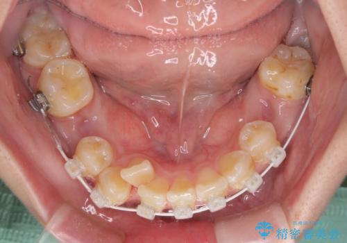 転位歯や埋伏歯などの難易度の高い抜歯矯正治療の治療中