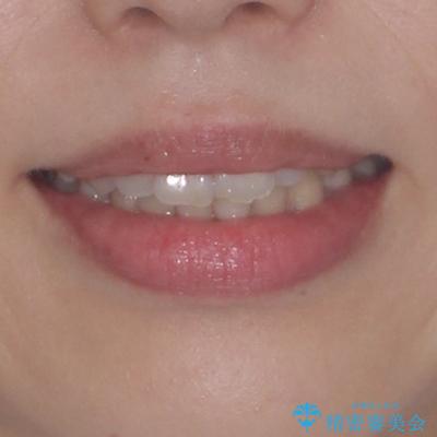 インビザライン・モデレートを用いて気になる後戻りを矯正治療の治療前(顔貌)