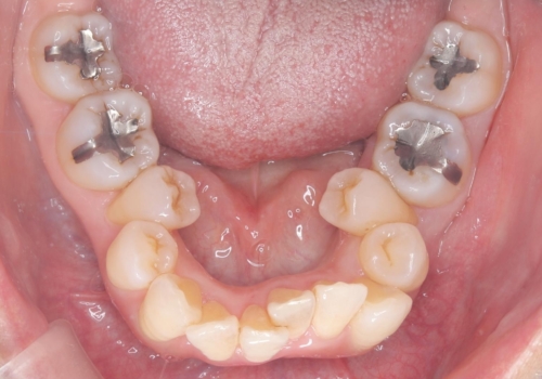 【セラミックインレー】口の中の銀の詰め物を白い物に替えたいの治療前