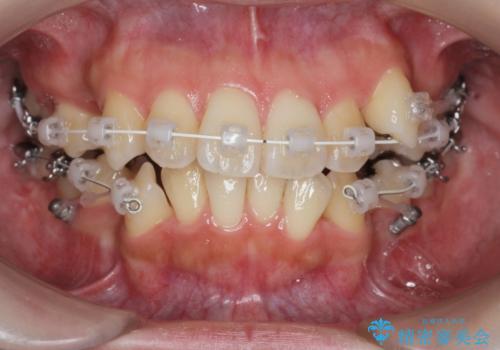 八重歯を矯正治療で治したい!の治療前