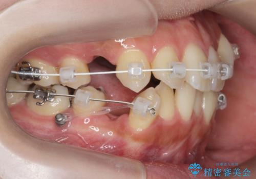 八重歯を矯正治療で治したい!の治療前