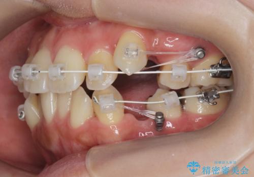 八重歯を矯正治療で治したい!の治療前