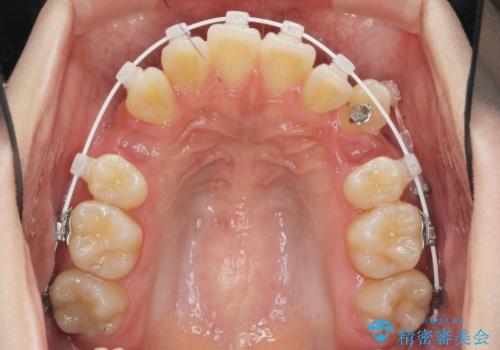 八重歯を矯正治療で治したい!の治療前