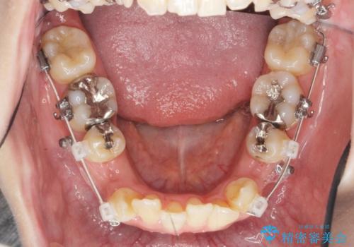 八重歯を矯正治療で治したい!の治療前