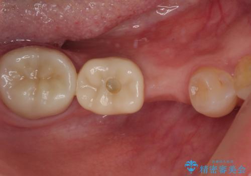 割れてしまった奥歯 インプラント治療の治療前