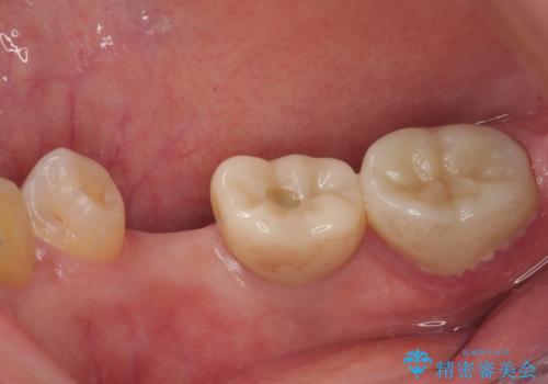 割れてしまった奥歯 インプラント治療の治療前