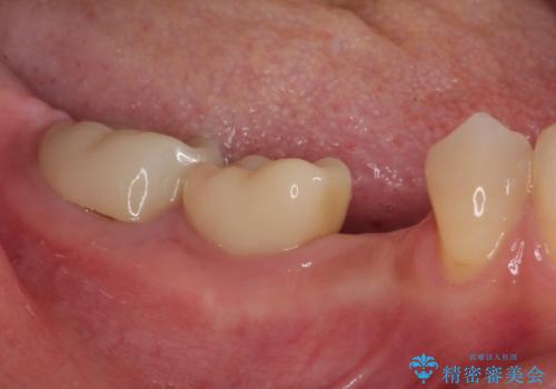 割れてしまった奥歯 インプラント治療の治療前